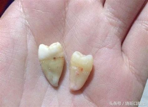 拔下來的牙齒怎麼處理 痣形成的原因